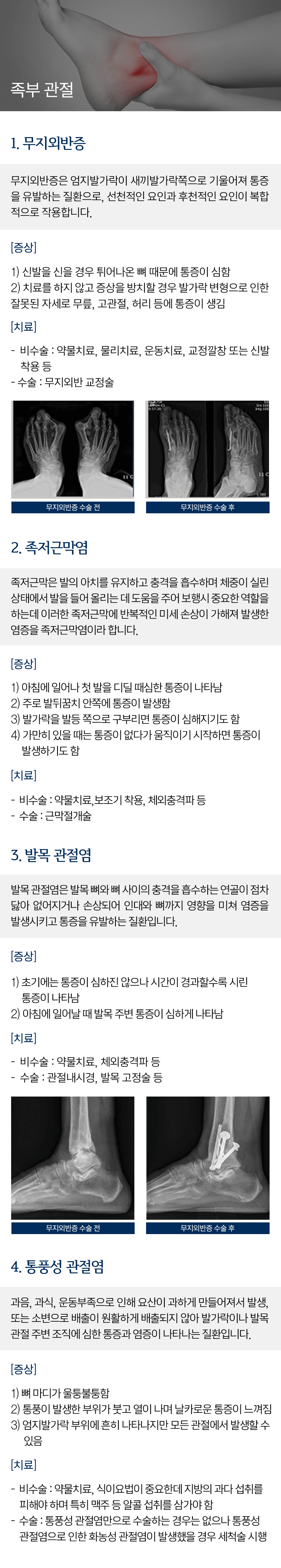 족부 관절