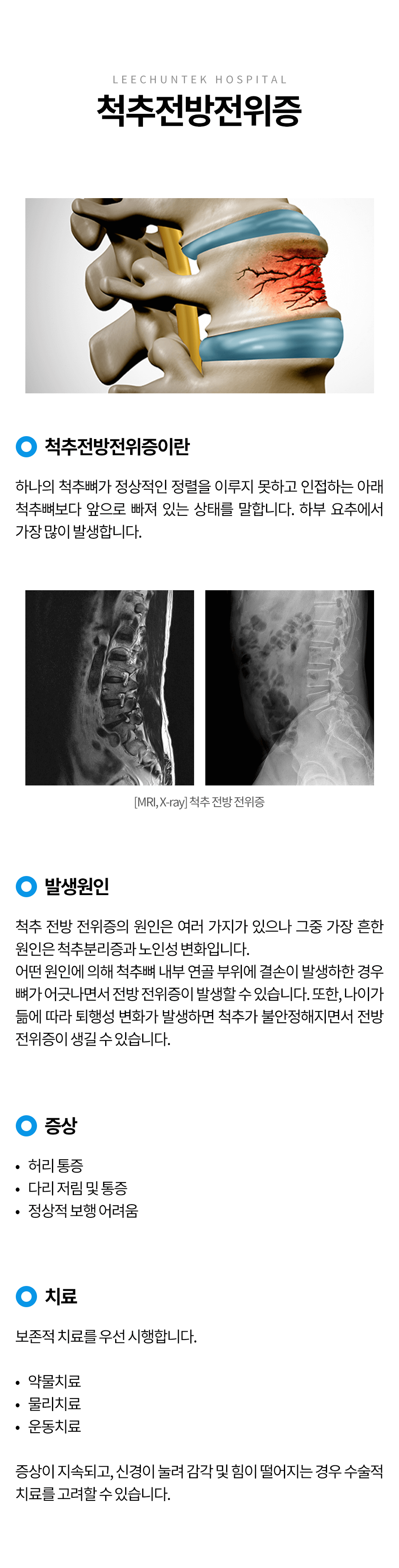 척추전방전위증