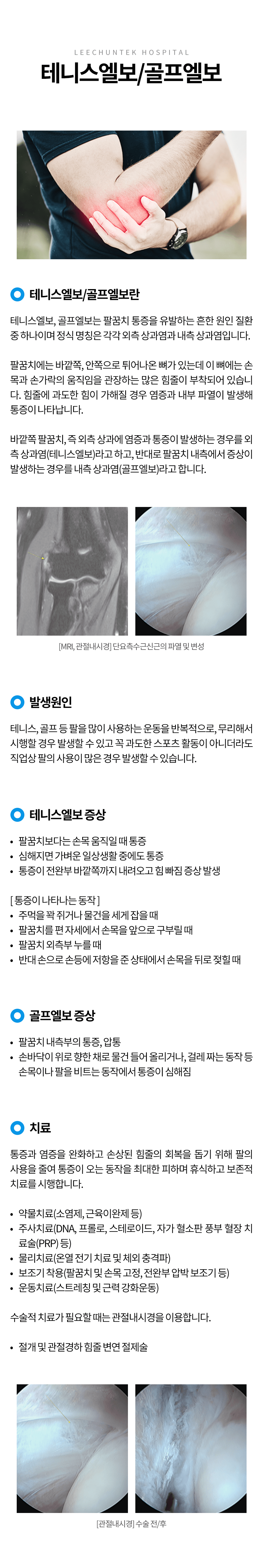 테니스엘보, 골프엘보