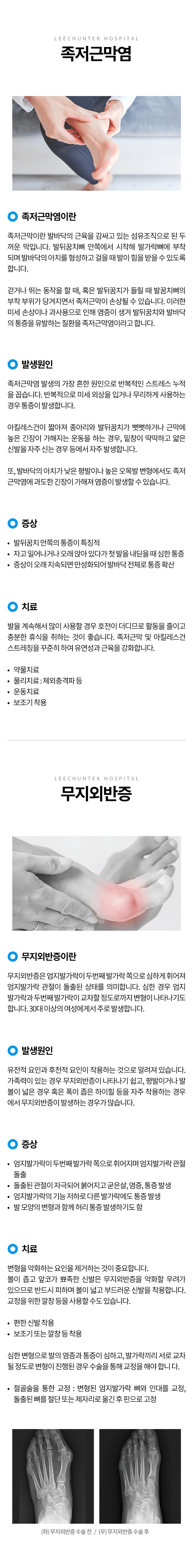 족저근막염, 무지외반증